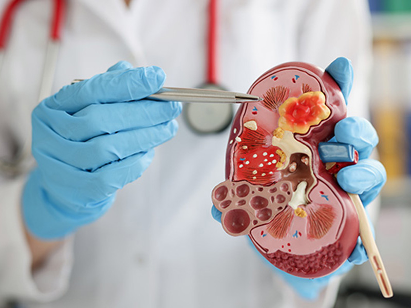 Close-up of urologist pointing pen kidney structure on anatomical model. Treatment of kidney diseases, pyelonephritis